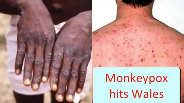 WARNING:  Covid vaccines have just caused MONKEYPOX in Wales